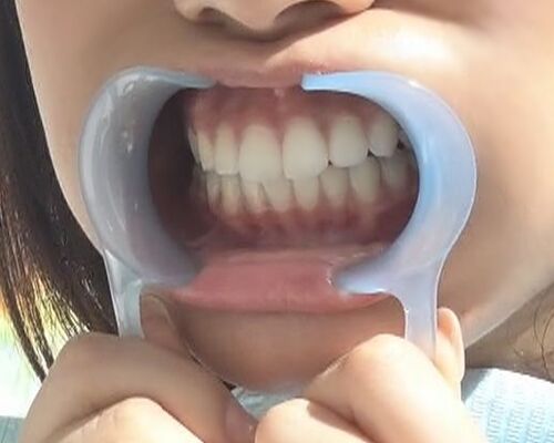 ホワイトニング